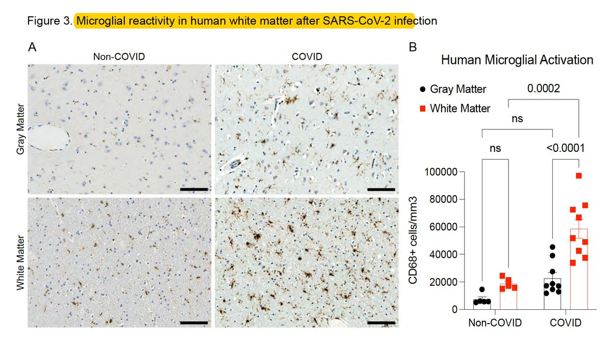 Eric Topol (@erictopol) on Twitter photo How #LongCovid brain fog resembles cancer "chemo-brain." An experimental model of mild Covid infection demonstrates microglial activation, loss of oligodendrocytes, confirmed at post-mortem in 9 people
biorxiv.org/content/10.110… <a href="/VirusesImmunity/">Prof. Akiko Iwasaki</a> <a href="/michelle_monje/">Michelle Monje🎗️ 🟦</a> How #LongCovid brain fog resembles cancer "chemo-brain." An experimental model of mild Covid infection demonstrates microglial activation, loss of oligodendrocytes, confirmed at post-mortem in 9 people
biorxiv.org/content/10.110… <a href="/VirusesImmunity/">Prof. Akiko Iwasaki</a> <a href="/michelle_monje/">Michelle Monje🎗️ 🟦</a>