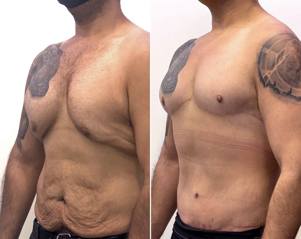 The Cosmetic Lane on X Male Body Lift Gynecomastia to remove the saggy skin around the chest area Tummy Tuck to eliminate the saggy skin around the abdomen. https t pI7mw9AOfE