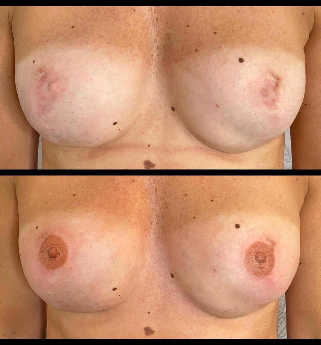 The Attic Permanent Cosmetics & Beauty (@attictanning) on Twitter photo A beautiful transformation following a double mastectomy for this lovely lady. 3D hyper realistic permanent nipple tattoos that won’t fade or need top up treatments
@worldmedicalartists @wma2021 <a href="/primroseunit/">The Primrose Foundation</a> @NHSKernow <a href="/RCHTWeCare/">Royal Cornwall Hospitals NHS Trust</a> <a href="/mermaidcentre/">The Mermaid Centre</a> @Boo3doc @MacmillanSWest A beautiful transformation following a double mastectomy for this lovely lady. 3D hyper realistic permanent nipple tattoos that won’t fade or need top up treatments
@worldmedicalartists @wma2021 <a href="/primroseunit/">The Primrose Foundation</a> @NHSKernow <a href="/RCHTWeCare/">Royal Cornwall Hospitals NHS Trust</a> <a href="/mermaidcentre/">The Mermaid Centre</a> @Boo3doc @MacmillanSWest