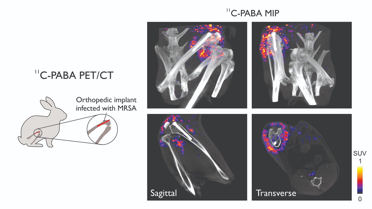 Alvaro A. Ordóñez (@alvaroaordonez) on Twitter photo Trouble diagnosing #MRSA prosthetic joint infections? Our work shows how bacteria-specific PET imaging can detect Staph infections in muscle, bone, and implants 🦿🦠. Great collaboration of <a href="/HopkinsMedicine/">Johns Hopkins Medicine</a> and <a href="/UCSFimaging/">UCSF Imaging</a> just published in <a href="/JCI_insight/">JCI insight</a> insight.jci.org/articles/view/… Trouble diagnosing #MRSA prosthetic joint infections? Our work shows how bacteria-specific PET imaging can detect Staph infections in muscle, bone, and implants 🦿🦠. Great collaboration of <a href="/HopkinsMedicine/">Johns Hopkins Medicine</a> and <a href="/UCSFimaging/">UCSF Imaging</a> just published in <a href="/JCI_insight/">JCI insight</a> insight.jci.org/articles/view/…