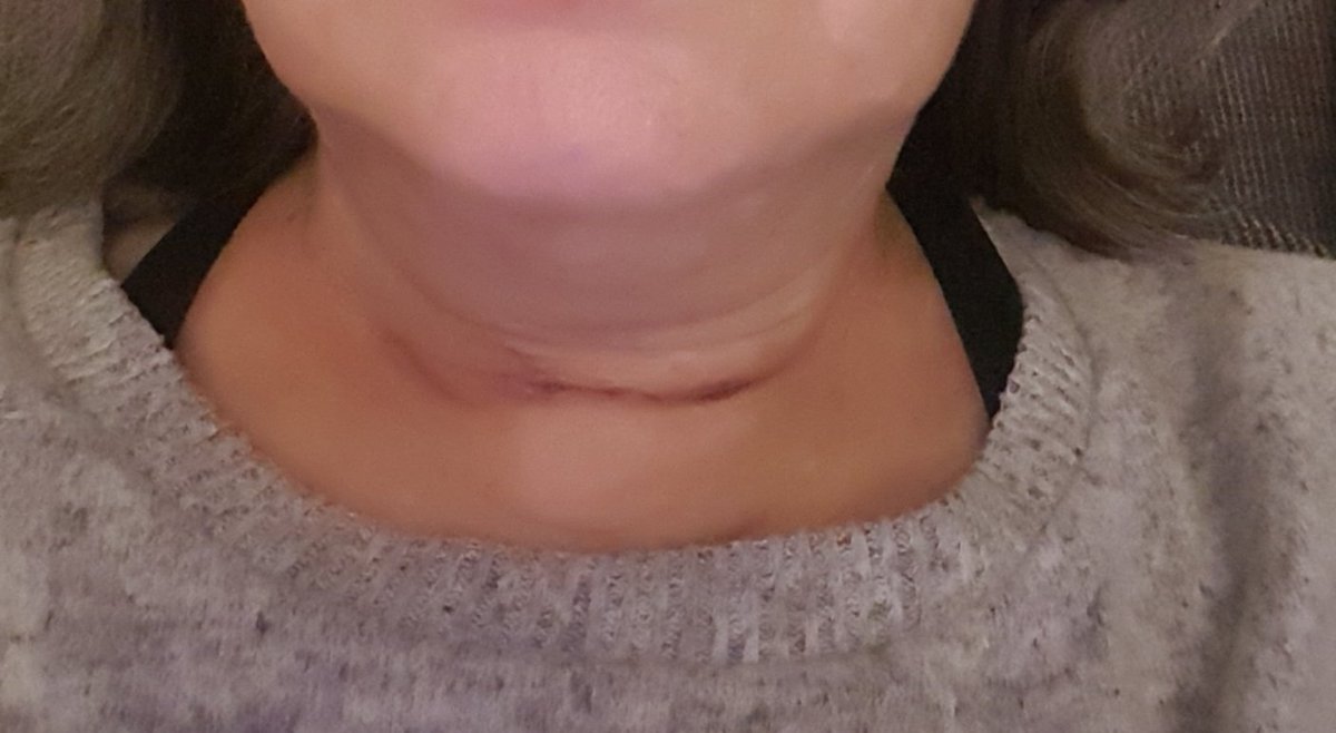 juliawright0405's tweet photo. Hello! Long time no tweet. I've been ill for a couple of years with hyperparathyriodism. So l had one of my parathyroid glands removed on December 22nd. The wound is healing well but my symptoms have not improved at all, except the calcium level in my blood is back to normal. https://t.co/uNuEtDwrVW