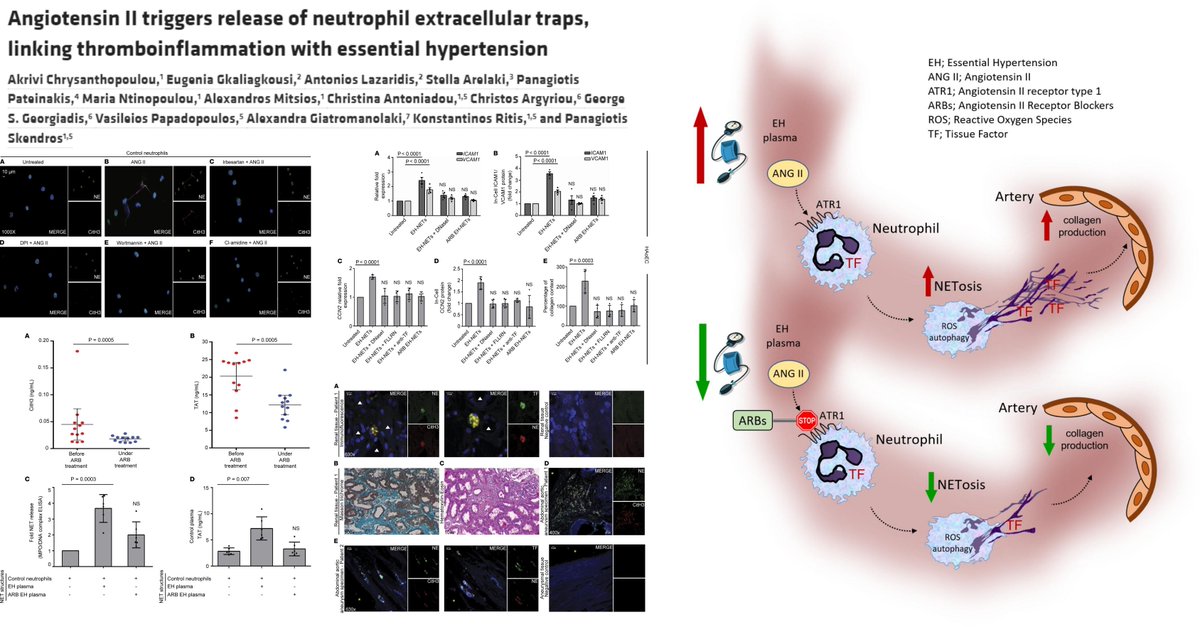 #Hypertensin #NeutrophilExtracellularTrap

Important evidence on Neutrophil in cell/organ damage in #EssentialHypertension

Angiotensin II --> #NETosis + potential roles of NADPHoxidase2 & #Autophagy

Dr Panagiotis Skendros lab @JCI_insight 2021 @PSkendros
insight.jci.org/articles/view/…
