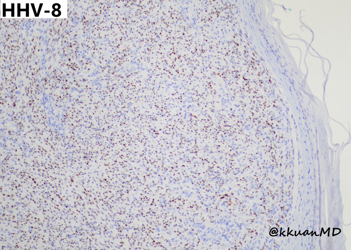 Cutaneous Kaposi sarcoma from 35yo M with HIV/AIDS #PathTwitter #pathology #dermpath #dermtwitter #patheducation #infectiousdisease 
<a href="/EinsteinPath/">Einstein Montefiore Pathology</a> <a href="/NYPathSociety/">the New York Pathological Society</a> <a href="/Dr_Brian_Cox/">Brian Cox, MD, MAS</a> <a href="/anjuthevirgo/">Anju Pandey</a> <a href="/Rebecca_MMR/">Rebecca M. Marrero Rolon</a> <a href="/CzajaRebecca/">Rebecca Czaja</a> <a href="/JMGardnerMD/">Jerad Gardner, MD</a> <a href="/TristanRutland7/">Tristan Rutland MBBS FRCPA IFCAP</a> <a href="/DrGeeONE/">Olaleke Folaranmi</a>