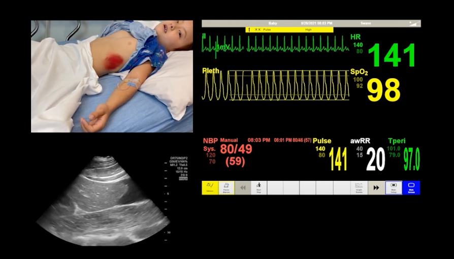 simsaveslives (@drauerbach) on Twitter photo Simbox Trauma for EMS and Hospitals is available NOW!
FREE Open Access "off the shelf" 10 min sim
Instructions included (no need for sim or peds expert)
bit.ly/336sqDh
Try it, share it, make your own, provide feedback
<a href="/acsTrauma/">The ACS Committee on Trauma</a> <a href="/EMSCImprovement/">EMSC Innovation & Improvement Center</a> <a href="/PediTraumaSoc/">Pediatric Trauma Soc</a> Simbox Trauma for EMS and Hospitals is available NOW!
FREE Open Access "off the shelf" 10 min sim
Instructions included (no need for sim or peds expert)
bit.ly/336sqDh
Try it, share it, make your own, provide feedback
<a href="/acsTrauma/">The ACS Committee on Trauma</a> <a href="/EMSCImprovement/">EMSC Innovation & Improvement Center</a> <a href="/PediTraumaSoc/">Pediatric Trauma Soc</a>