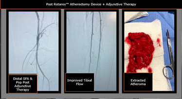 Todd_BDPI's tweet photo. Occluded left external iliac, CFA and thrombosed bypass graft. Awesome results Dr. Akuma #RemoveWithRotarex

Not for use in the cardiopulmonary, coronary, carotid, cerebral, renal or venous vasculature. Info: https://t.co/K0GcNOIi9p https://t.co/H7elRXem2w
