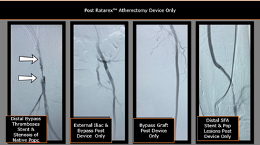 Todd_BDPI's tweet photo. Occluded left external iliac, CFA and thrombosed bypass graft. Awesome results Dr. Akuma #RemoveWithRotarex

Not for use in the cardiopulmonary, coronary, carotid, cerebral, renal or venous vasculature. Info: https://t.co/K0GcNOIi9p https://t.co/H7elRXem2w