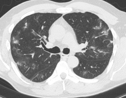 MayoPCCM's tweet photo. #CT chest: extensive patchy bilateral regions of nodular #consolidation, #nodules, and #groundglass #opacities.
🤔 What's on your differential? https://t.co/1MtaAsFGpa