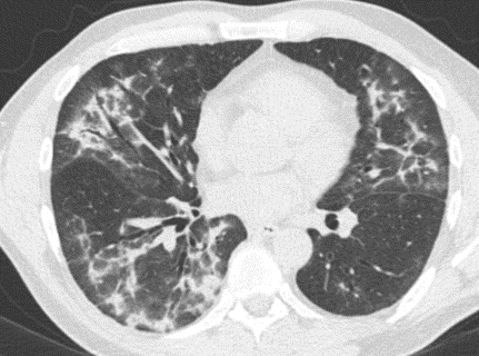 MayoPCCM's tweet photo. #CT chest: extensive patchy bilateral regions of nodular #consolidation, #nodules, and #groundglass #opacities.
🤔 What's on your differential? https://t.co/1MtaAsFGpa