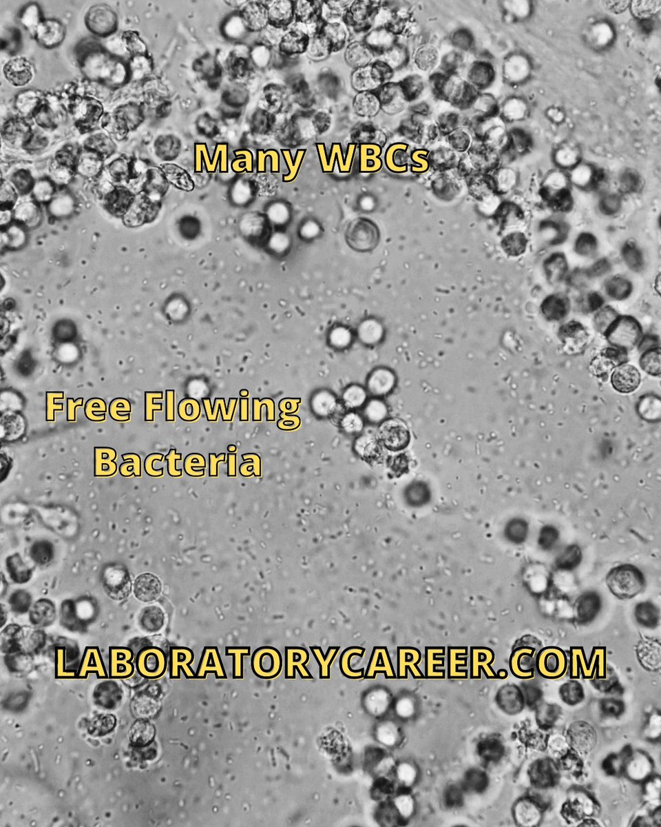 lab_career's tweet image. A photo ONLY A LAB TECH could admire! This beautiful UTI has numerous WBCs and rivers overflowing with bacteria. It is so cool to see these tiny organisms! 
#clinicallabscience #medicallabscience #laboratorycareer #sciencemajors