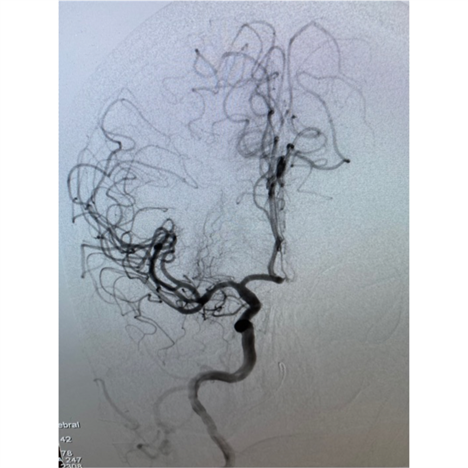 PenNeuro's tweet image. US HCPs: Dr. Allison Strickland from the University of Mississippi Medical Center uses #RED68 to achieve recanalization. #REDGlideDifference Rx only. For risk info: bit.ly/37YcYIU. Clinical results may vary.