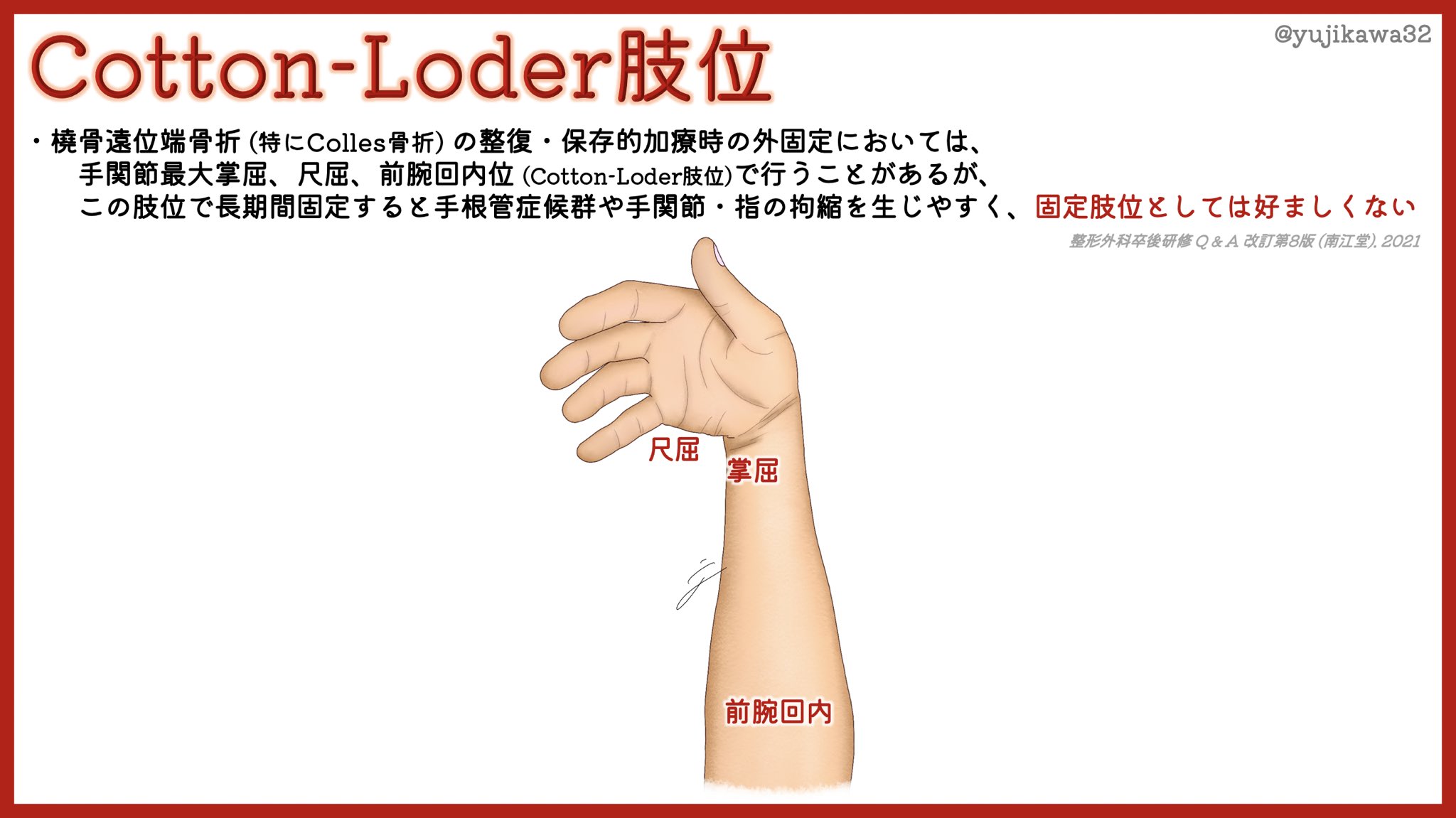 橈骨遠位端骨折 Twitter Search Twitter