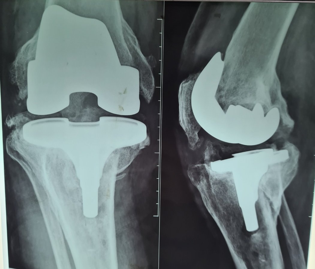 RomoOrtopedia's tweet photo. Knee fracture treated with knee replacement and now has a periprosthetic joint infection. https://t.co/EQtNqVbJ3l