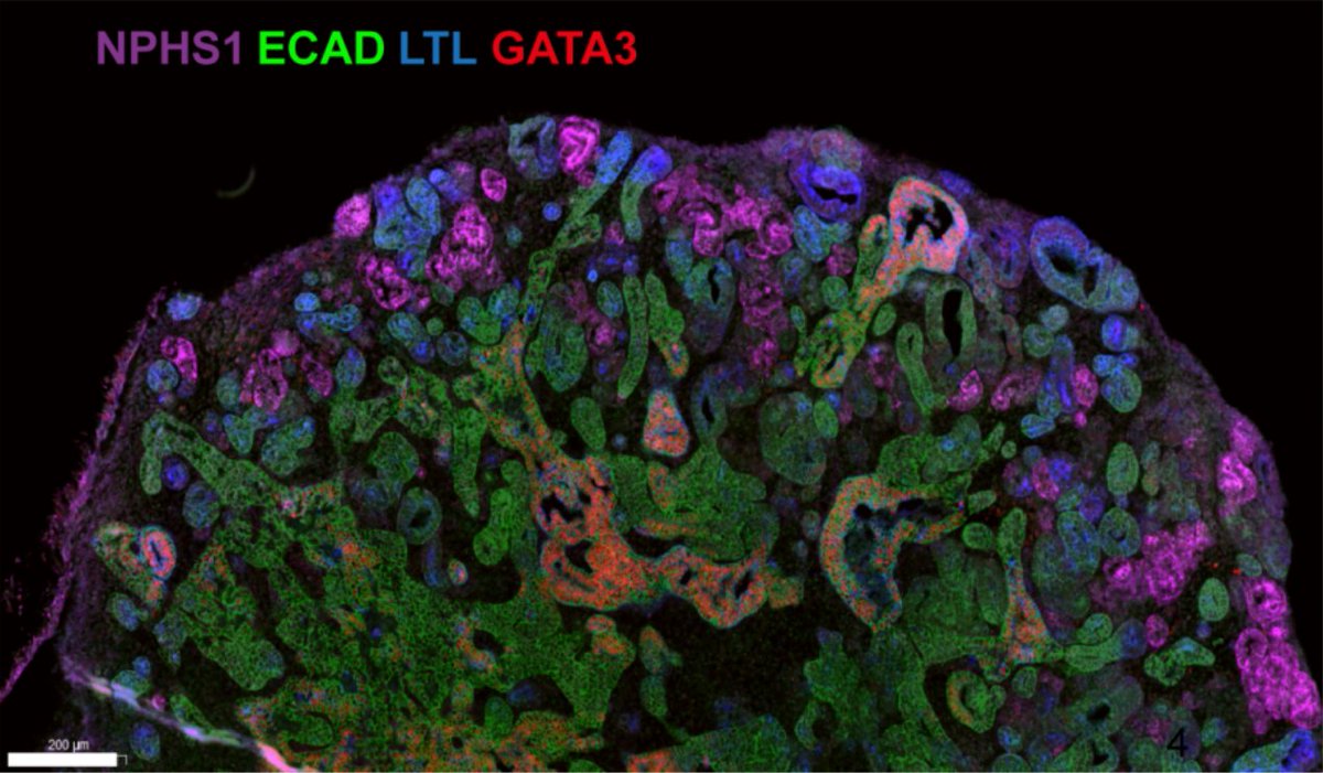 How does COVID-19 affect the kidney? 

Researchers at <a href="/RWTH/">RWTH Aachen</a> infected kidney #organoids with SARS-CoV-2, which led to #fibrosis.

<a href="/jansen_jitske/">Jitske Jansen</a> @kc_reimer <a href="/shin_nagai/">James Shiniti Nagai</a> <a href="/rkramann/">Rafael Kramann, MD PhD</a>

📎 <a href="/CellStemCell/">Cell Stem Cell</a>: bit.ly/3GnQVKy
🎧 Episode with discussion: bit.ly/3FctJxi