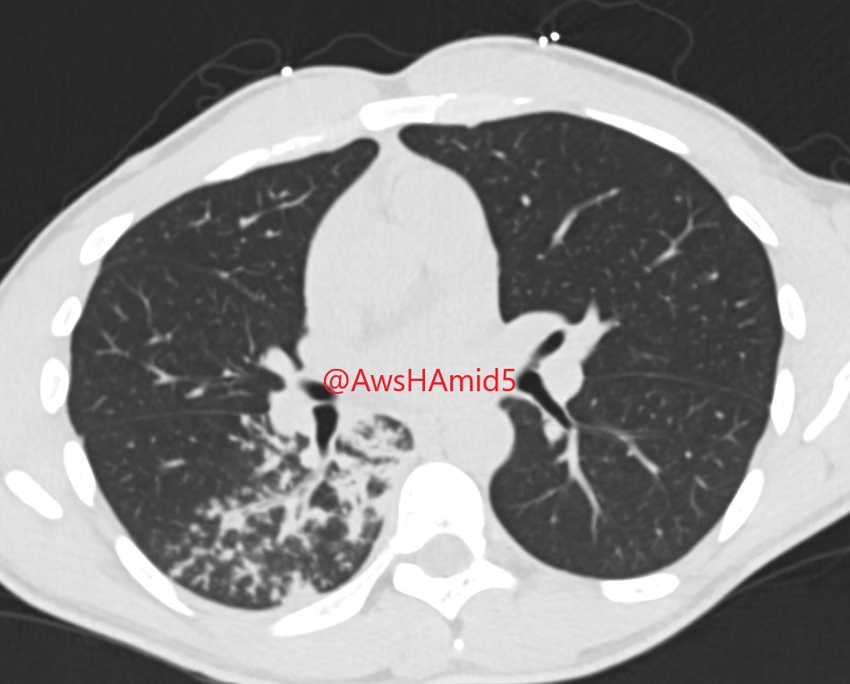 Case #25: Active TB (Postprimary TB) with endobronchial spread of infection in young age patient. Note the typical distribution of abnormalities in the posterior seg of RUL and superior seg of RLL #radiology #chestrad #radres #FOAMed #FOAMrad @EmoryRadiology @TLHM_MD @thoracicrad