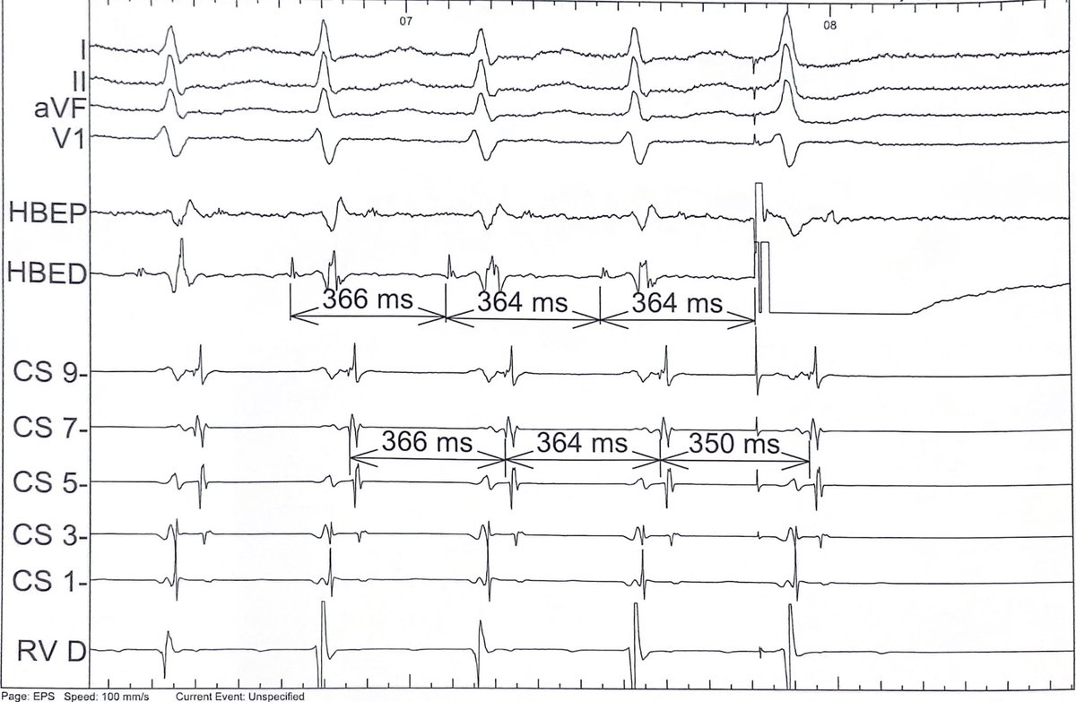 More fun with PJCs during SVT.  How is this possible?  What’s the diagnosis?