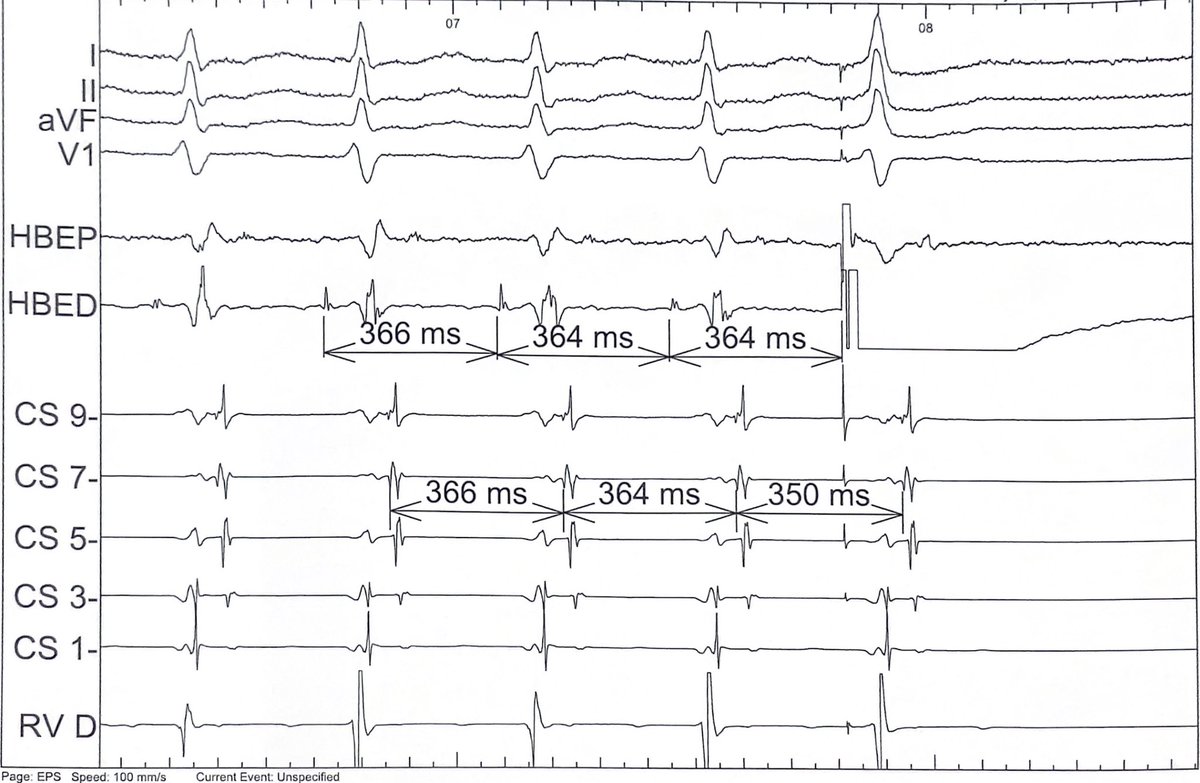More fun with PJCs during SVT. How is this possible? What’s the diagnosis?