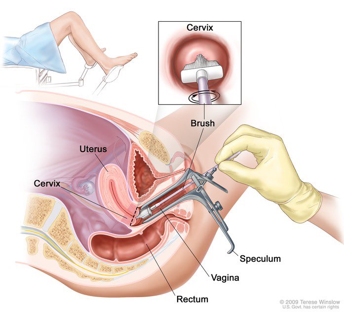 Takut bila tengok gambar ni tapi bila dah experience sendiri tak sakit pun rupanya 😂

Less than 5 mins dah settle. Siapa tak pernah buat lagi pap smear ni, pegi buat tau. Sangat penting untuk perempuan ☝🏻