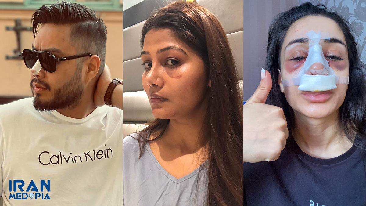 iranmedopia's tweet image. Any experience with #nosejob post-operation care?
#nosejob #postoperation #rhinoplasty #nosejobeiniran