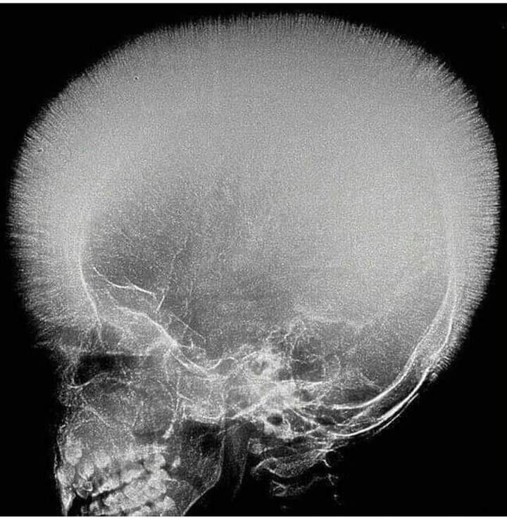 The most likely diagnosis?