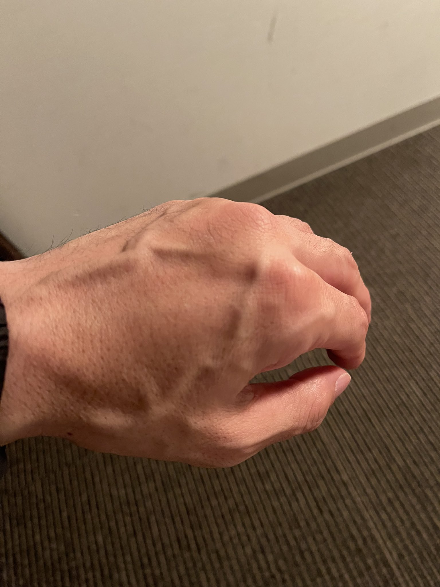 迫稔雄 なんか左拳が痛いなと感じる元旦 よくみてみたら腫れてる ヤバイボクシングやり過ぎた T Co Gq5qrzx6kl Twitter