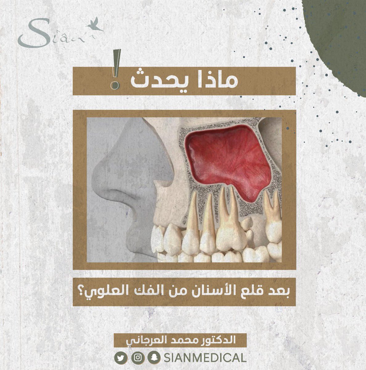 Ts1v23's tweet photo. #معلومة_طبية 💡مع الدكتور محمد العرجاني 

ماذا يحدث بعد خلع أسنان الفك العلوي ؟

#خلع_الاسنان #زراعة_اسنان #سيان #الخرج https://t.co/6d6Go9NCnc