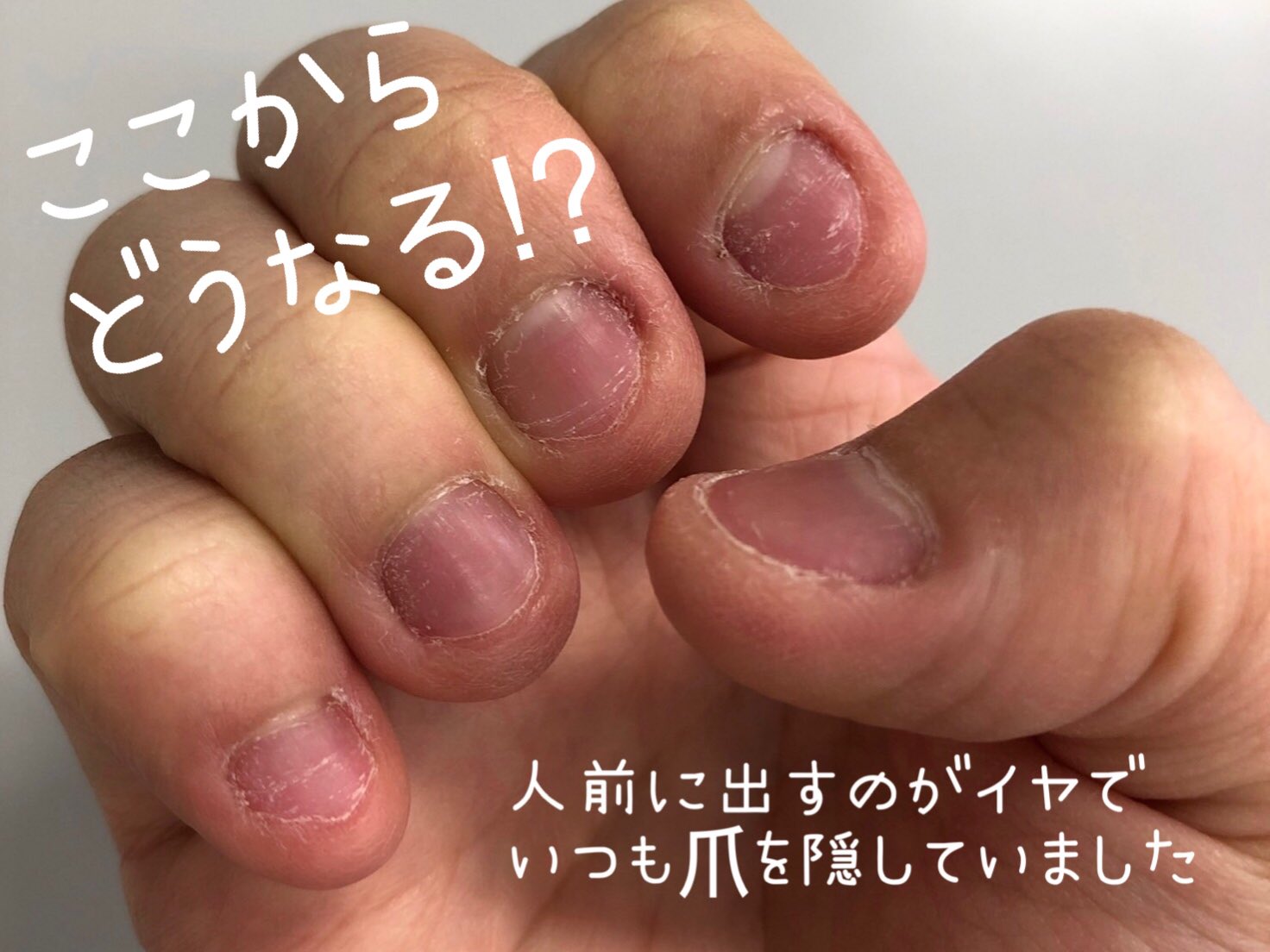 深爪緩和 自爪育成サロンanl Aube Ann1001ann Twitter