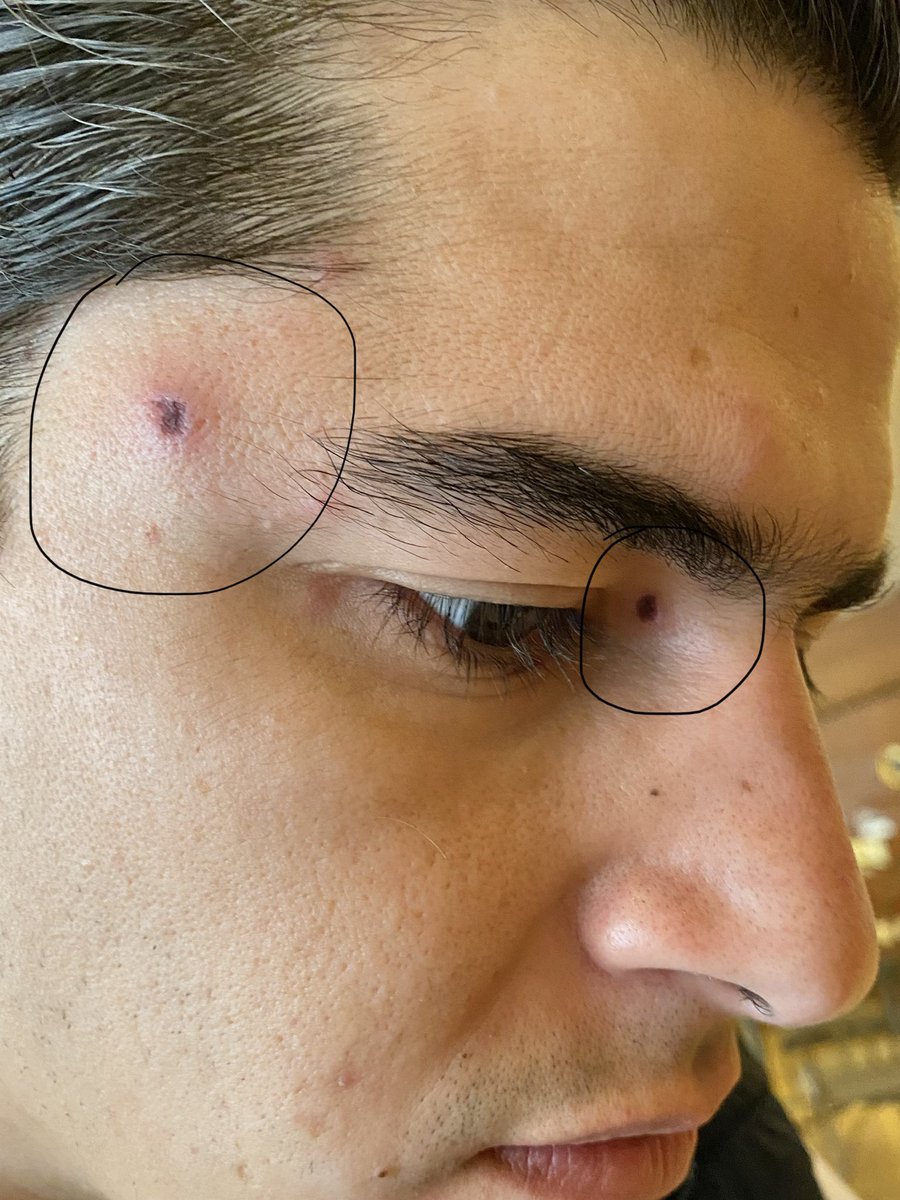 marlonlopp's tweet photo. @Arachno_Cosas Buenos días! Así han avanzando mis lesiones en una semana. Qué araña pudo ser? https://t.co/j3lio3pEUQ