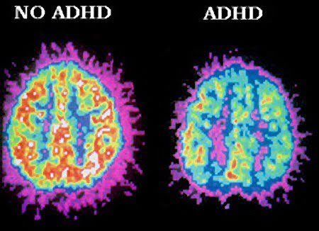 Em 01/01/2022, oficialmente, passa a valer a última atualização do CID-11, da OMS, onde nosso TDAH está agrupado como Transtorno de Neurodesenvolvimento junto com autismo e outras neurodivergências. É um passo para reconhecimento do TDAH como deficiência psicossocial na lei.