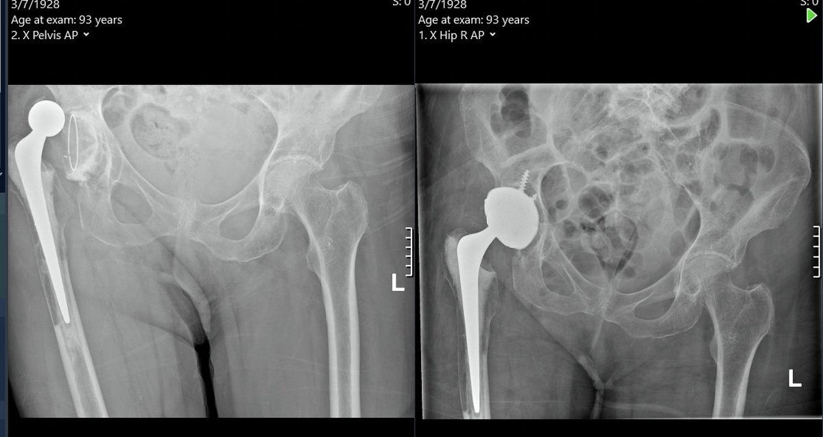 With permission, I share the results of a recent revision of a hip replacement I did in a 93 year old lady, who can now walk. It confirms that in certain circumstances, age is really just a number.