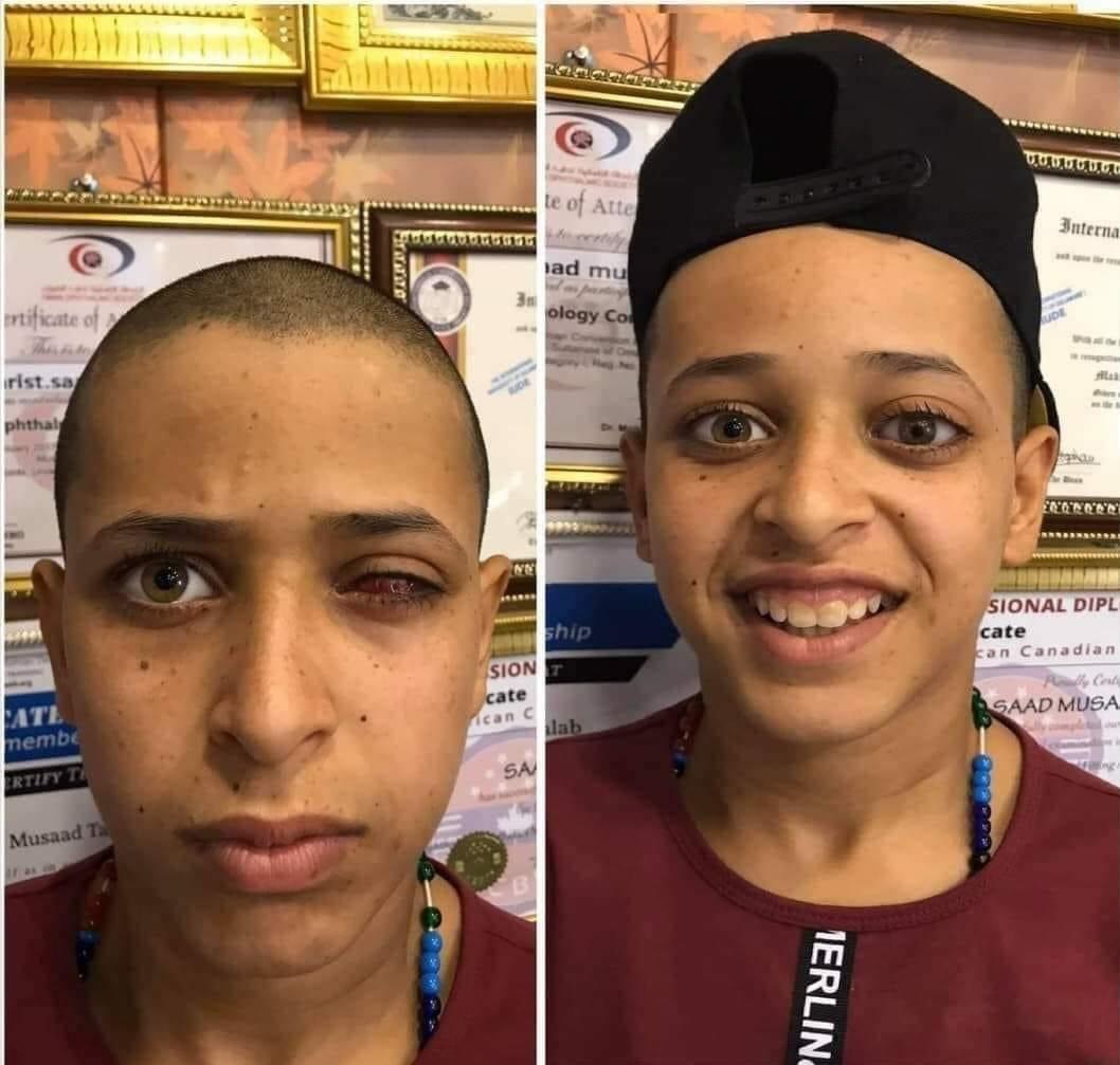 mortada_mr's tweet photo. شاب من محافظة الحله بعين
 واحدة والثانية لا يُبصر بها
لكن بصيرة الطبيب جعلتهُ 
يستعيد ابتسامته بعين اصطناعية تبرع بها
مجهود عظيم شكرآ لمن سعى برجوع هذه البسمة 

#ايجابيات https://t.co/Tvwyh2ElEj