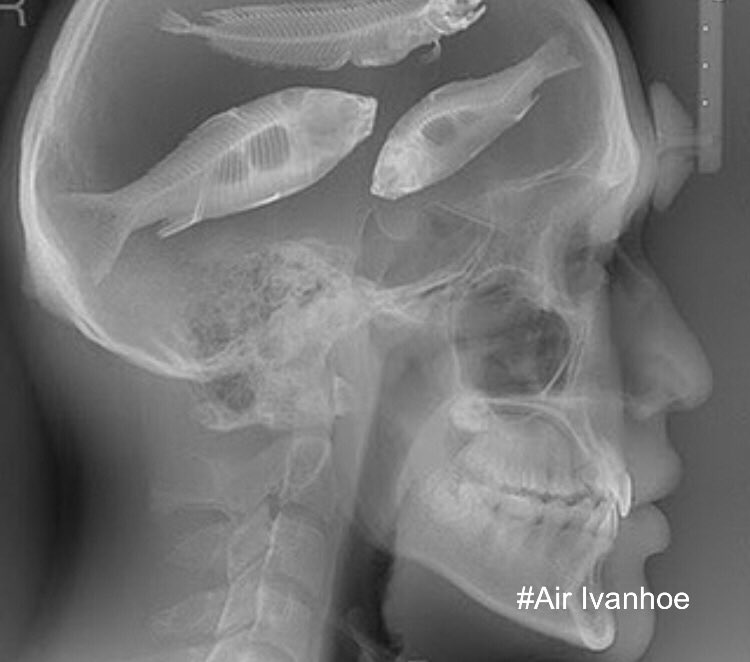 #FishBrains is the newest disease to hit the public in 2022.  Catching and eating fish with friends and family seems to be to blame.  HELP SPREAD awareness of this most entertaining  and least expensive hobby.  Wear your safety glasses - good luck my people ;) #airivanhoe #comedy