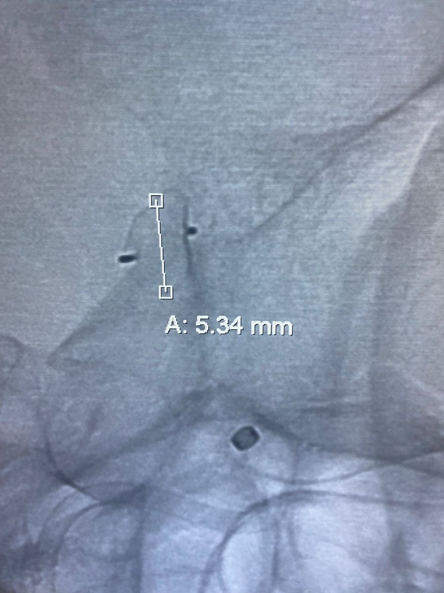 NIRAbbott's tweet photo. We achieved adequate LC (nominal - mean implanted WEB width at equator) of 1.1mm. For a 6mm WEB w recommend 1mm of LC
#JustWEBit #WEB17 https://t.co/H7166gms2A