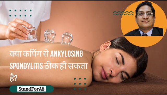 doctorakerkar's tweet image. Cupping in hindi: क्या Cupping (कपिंग) से ankylosing spondylitis ठीक हो सकता है?
youtu.be/ySoHirOMHM4
#AnkylosingSpondylitis #AxSpA