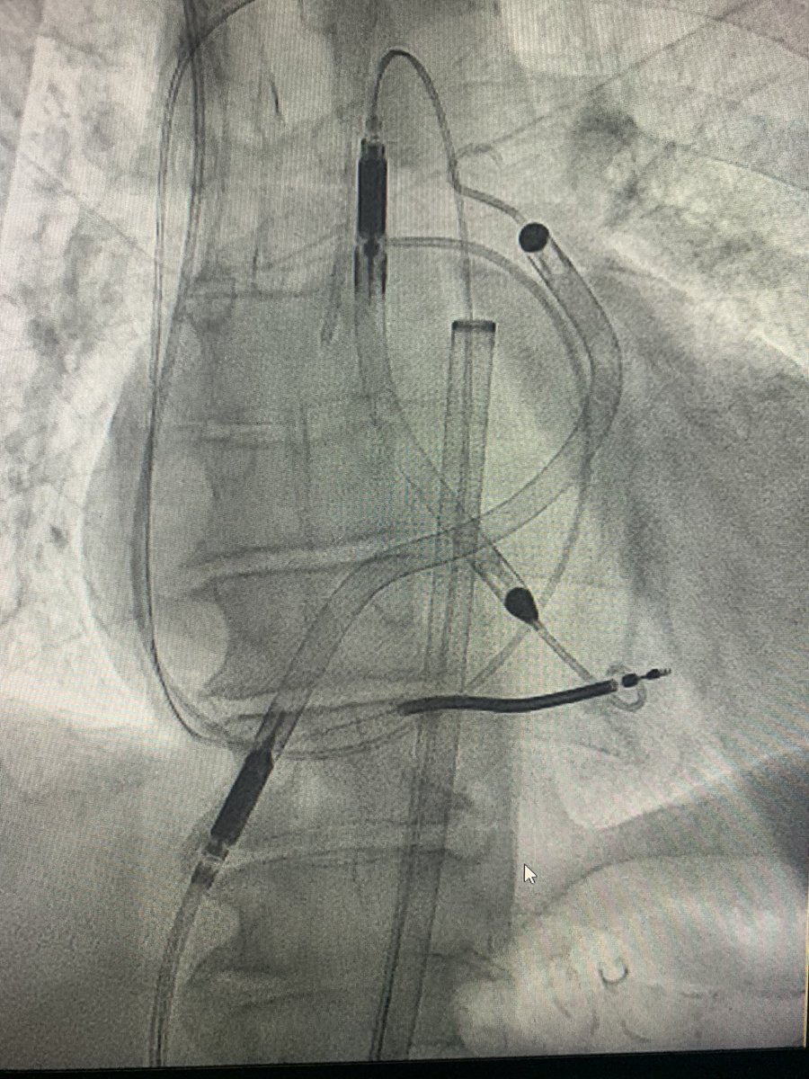 AlejandroLemor's tweet image. I welcomed 2022 with a midnight #transcaval #Impella 5.0 + Impella RP for biventricular shock.   Finished the day with a Transcaval #TandemHeart in a patient with L-TGA in shock.  @PedroMDMSc @HenryFordNews @Babar_Basir @BillONeillMD @yaqoub_lina @Abiomed