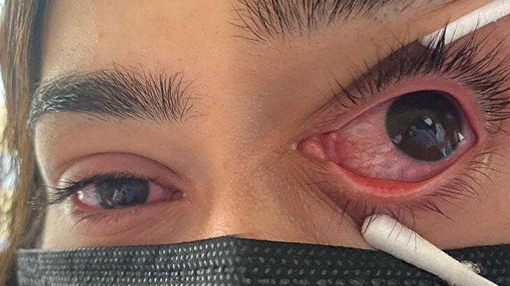 Şimdi de gözlerde virüs salgını! Uzmanlar adenovirüse karşı uyarıyor

🖇 mill.yt/jzf4u