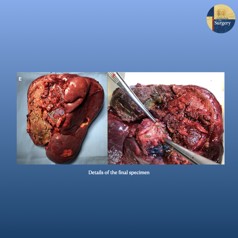 UpdatesSurgery's tweet photo. Robotic liver partition and portal vein embolization for staged #hepatectomy for perihilar #cholangiocarcinoma

https://t.co/lKi628zoCL

#HPBsurgery #livertwitter https://t.co/7CDgoo4K7z
