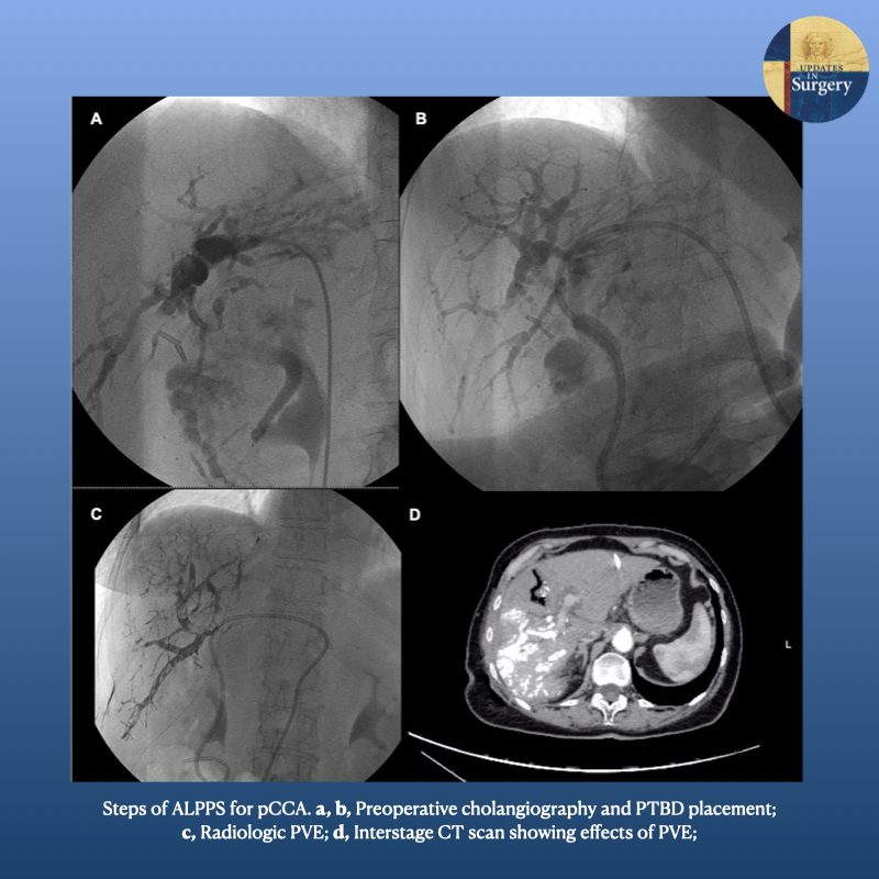 UpdatesSurgery's tweet photo. Robotic liver partition and portal vein embolization for staged #hepatectomy for perihilar #cholangiocarcinoma

https://t.co/lKi628zoCL

#HPBsurgery #livertwitter https://t.co/7CDgoo4K7z
