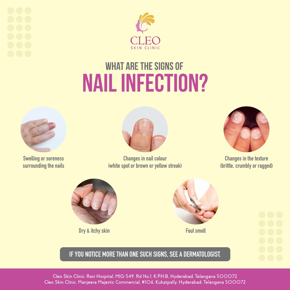 A fungal nail infection, also known as onychomycosis or tinea unguium, occurs when a fungus that's normally in your fingernails or toenails overgrows.
#nailinfection #hyderabadskindoctor #kukatpallyhospital #hyderabadhospital #kukatpallyderatologist