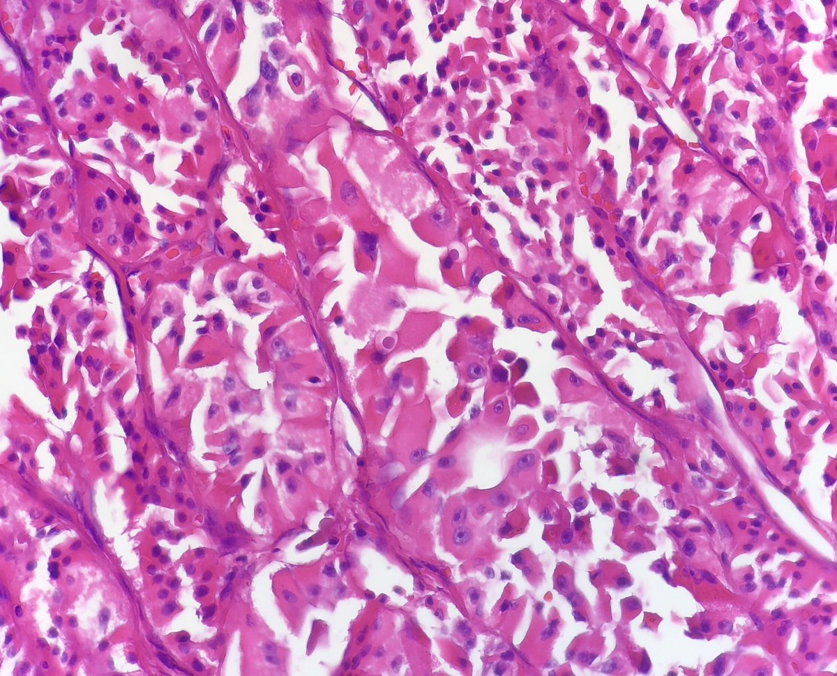 pembeoltulu's tweet photo. 5- Histologic sections #cytohistopath #thyroid #EndPath https://t.co/rhmkG0gX93