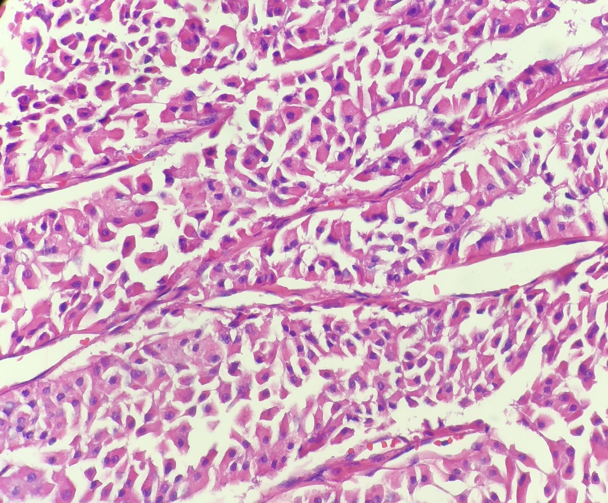 pembeoltulu's tweet photo. 5- Histologic sections #cytohistopath #thyroid #EndPath https://t.co/rhmkG0gX93