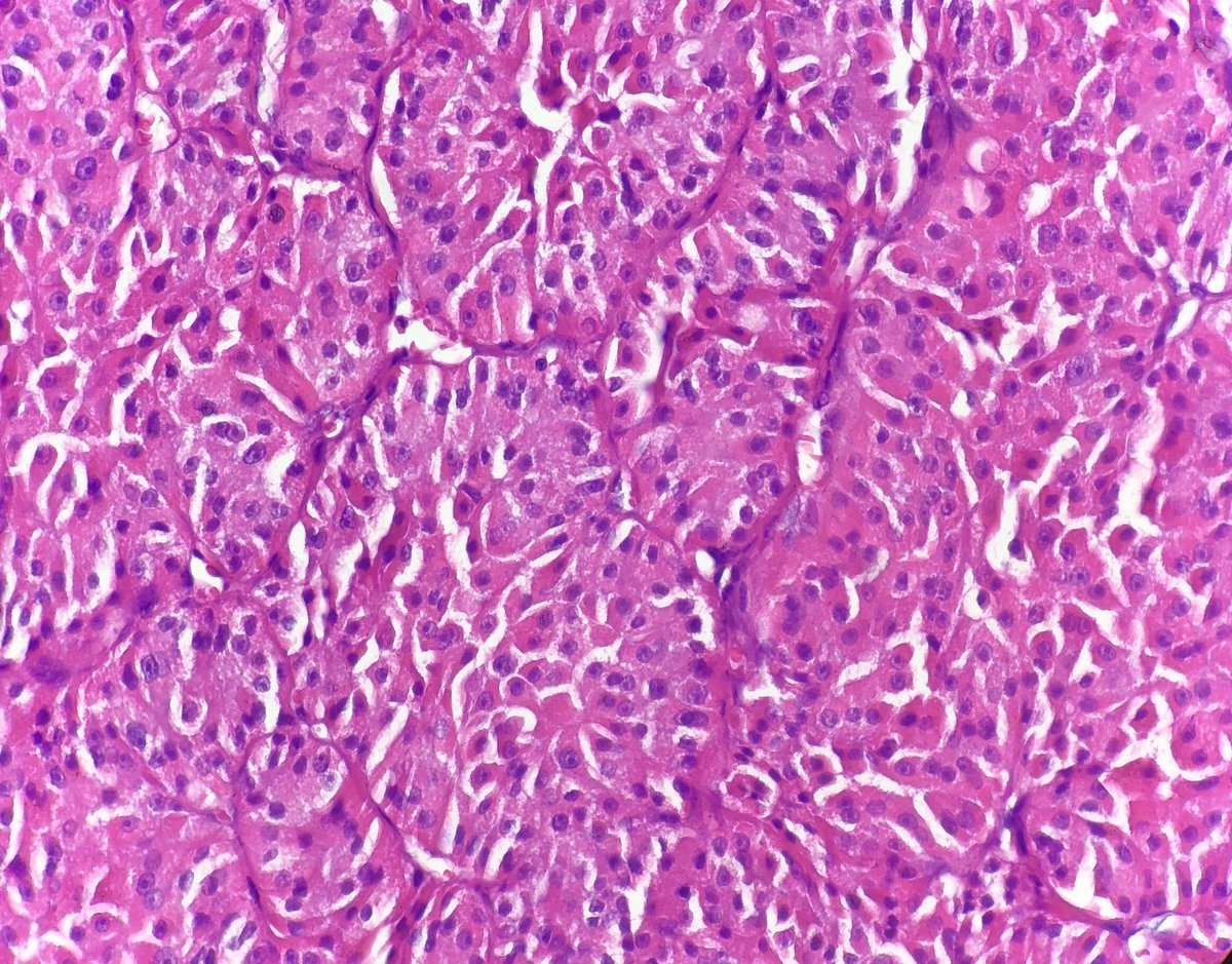 pembeoltulu's tweet photo. 5- Histologic sections #cytohistopath #thyroid #EndPath https://t.co/rhmkG0gX93
