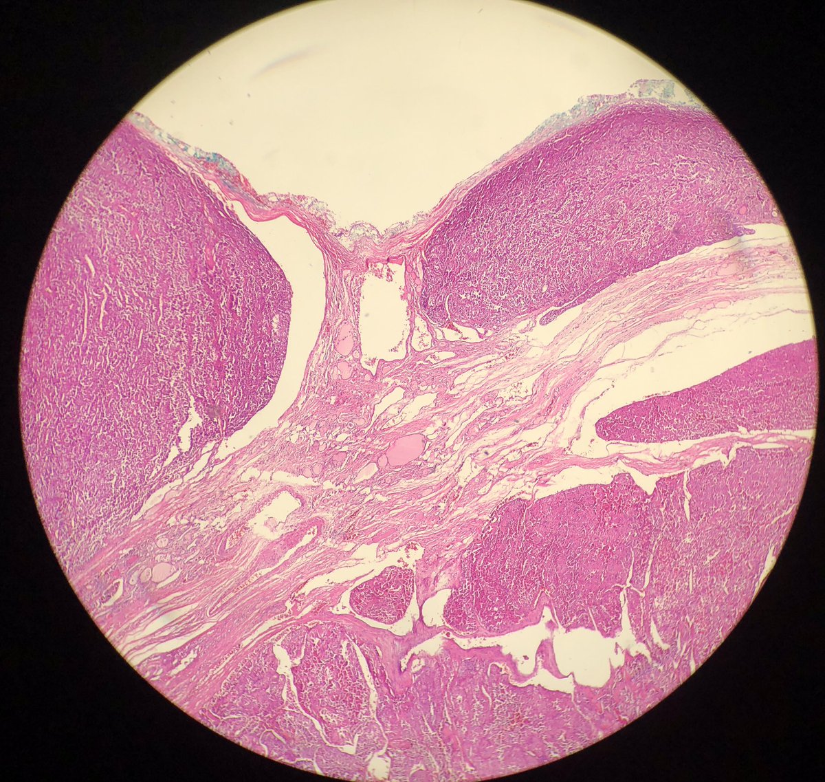 pembeoltulu's tweet photo. 1-Histologic sections #cytohistopath #thyroid #EndPath https://t.co/WrkqNCWs3z