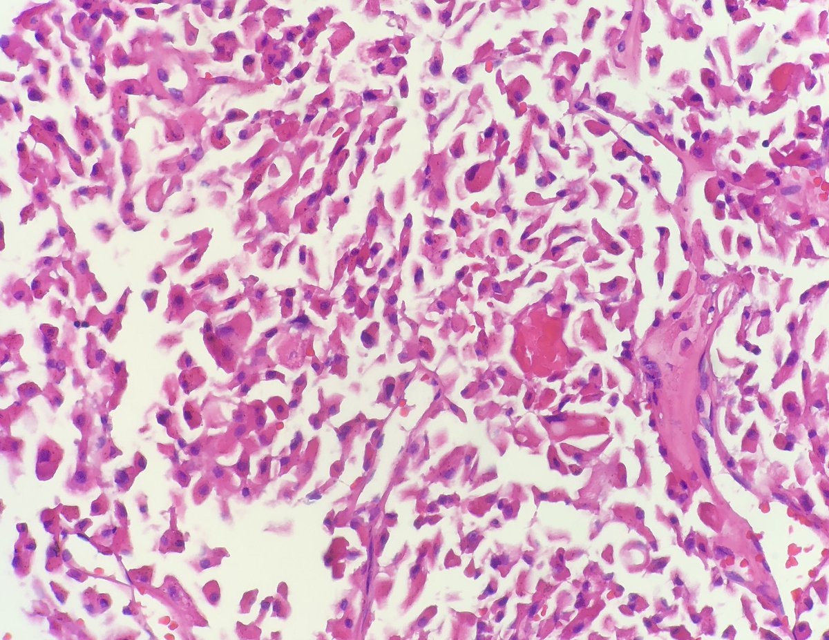 pembeoltulu's tweet photo. 2-Histologic sections #cytohistopath #thyroid #EndPath https://t.co/dJ72uCvid9