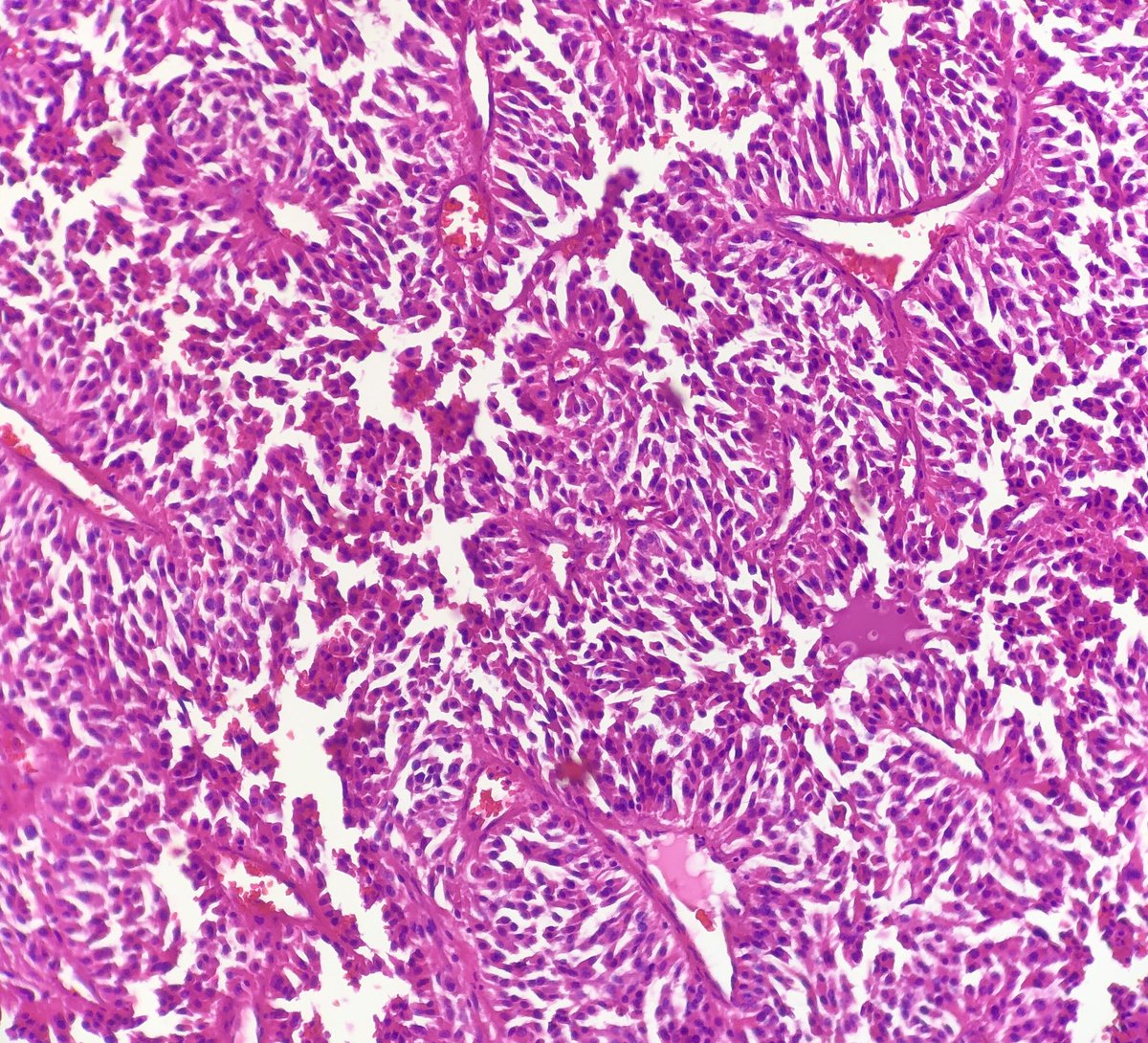 pembeoltulu's tweet photo. 2-Histologic sections #cytohistopath #thyroid #EndPath https://t.co/dJ72uCvid9