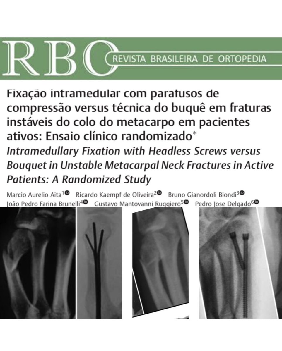 Publicamos mais um artigo científico na RBO <a href="/sbotnacional/">SBOT Nacional</a> 
É uma revisão comprando os resultados de pacientes com fratura do colo do 5 metacarpo - Fratura de Boxer. Usamos a técnica de parafusos de compressão intramedular e fios intramedular
Confira em rbo.org.br