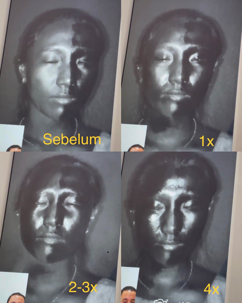 funskincare_'s tweet image. Sunscreen spray di bawah kamera UV #funexperiment 🧐 gimana sih kelihatannya dibandingkan dengan UV cream? Mari kita cek dan diskusi sama-sama