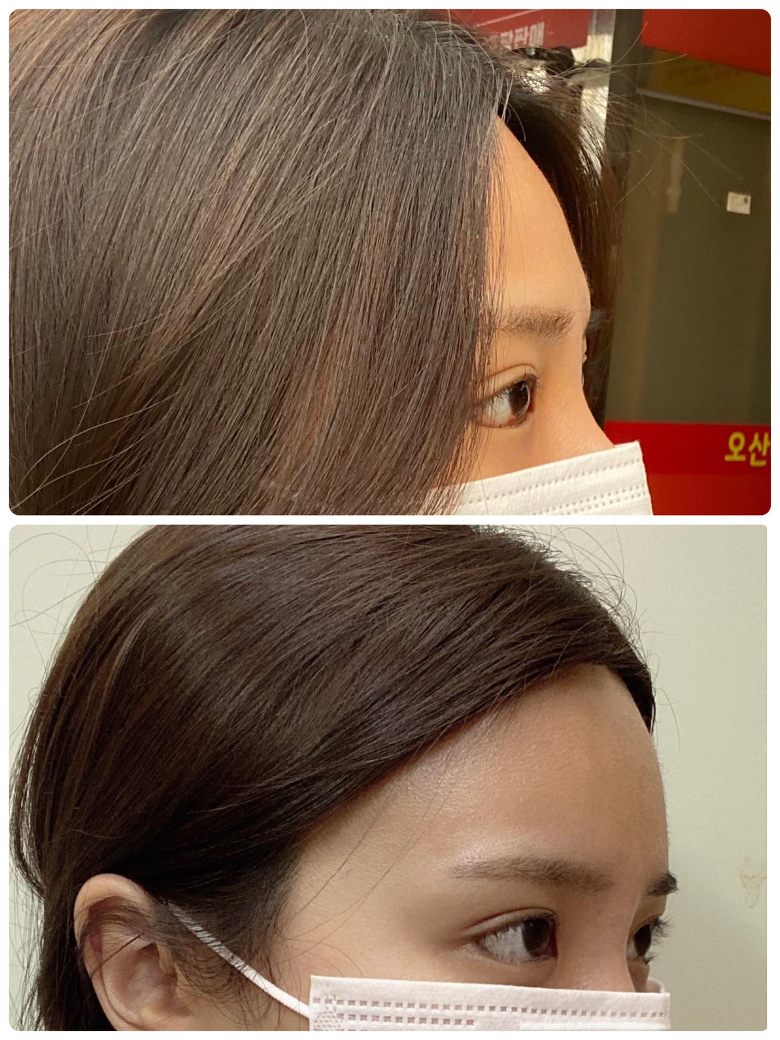 おでこ整形 Twitter Search Twitter