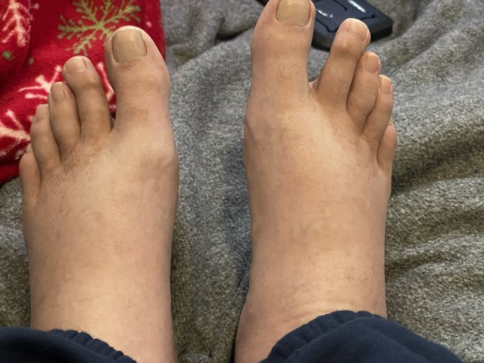 I just realized both my feet have bloated up with a burning sensation and I'm weak in both legs and knees