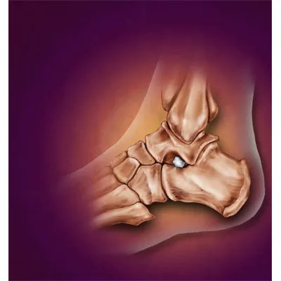 Medillustrates's tweet photo. Subtalar joint arthroereisis illustration by Nicole M. Jones.
Explore more of her work: https://t.co/7Eg7C9tErR
#subtalarjoint #implant #footanatomy #anklejoints #orthopaedics #injuries #patienteducation #medicaldevices #medical #illustration #medicalillustration #sciart #moa https://t.co/dLQMYT59fh