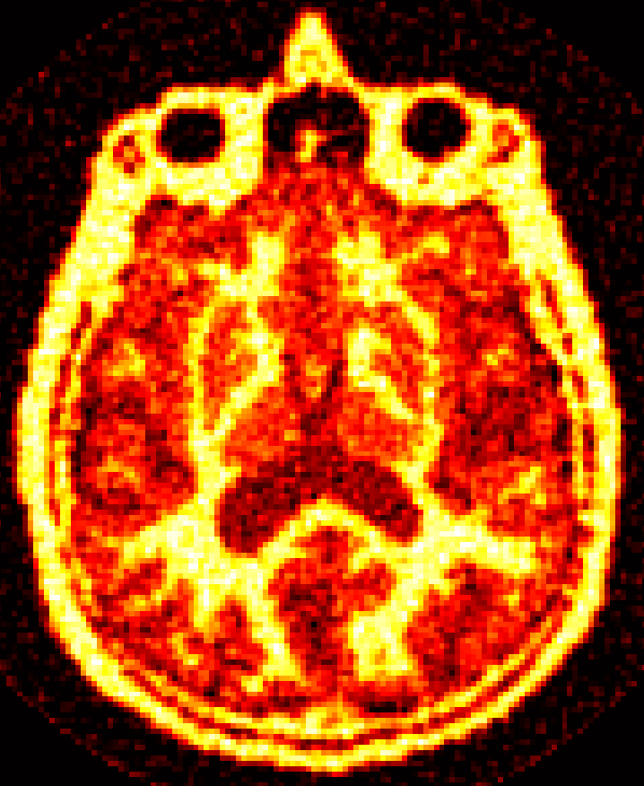 LarryPierceUW's tweet photo. A nice image from our MFM uncollimated SPECT system (simulated data, we're raising money for the prototype now). #SPECT #nuclearmedicine #UWmedicine https://t.co/uUEsmPWLUI